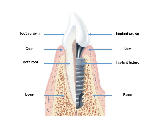 dental implants