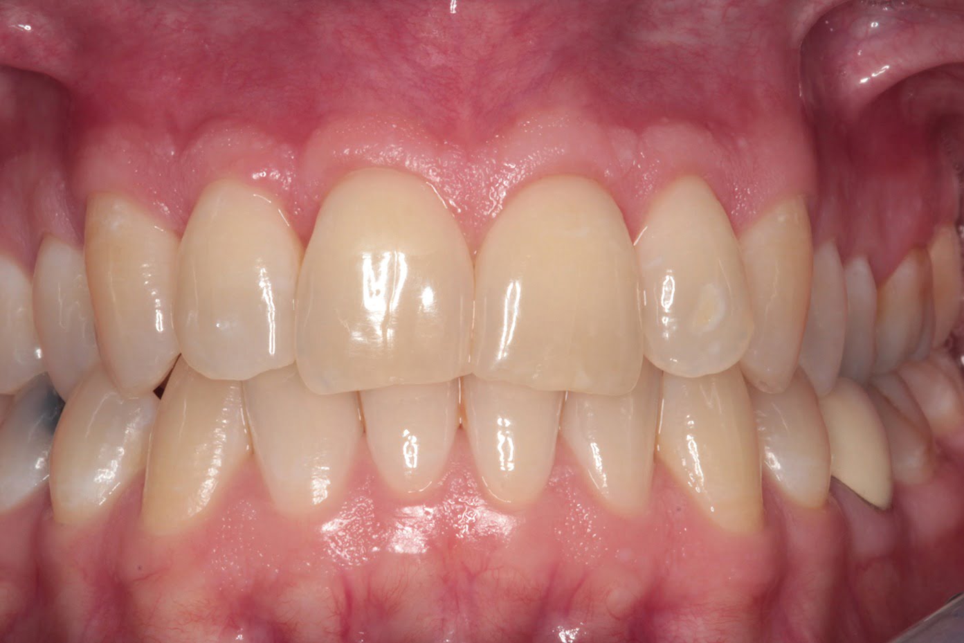 Receding gums Treatment Weybridge Retreating gums Woking