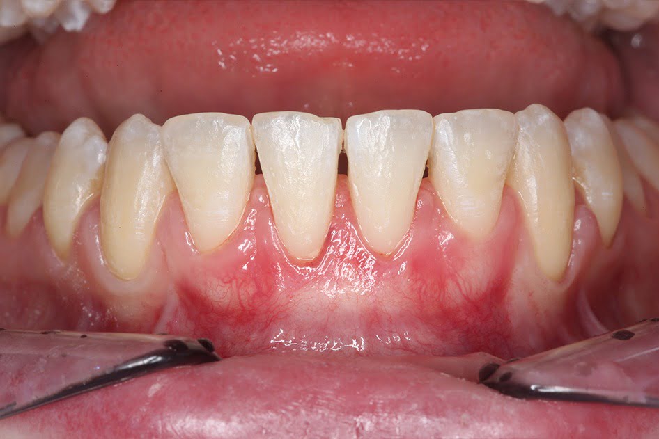 Go Dentistry Gum Recession After