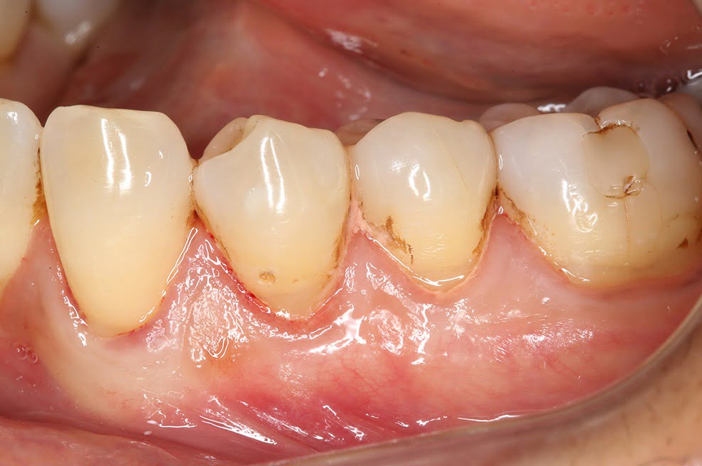 Receding gums Treatment Weybridge Retreating gums Woking