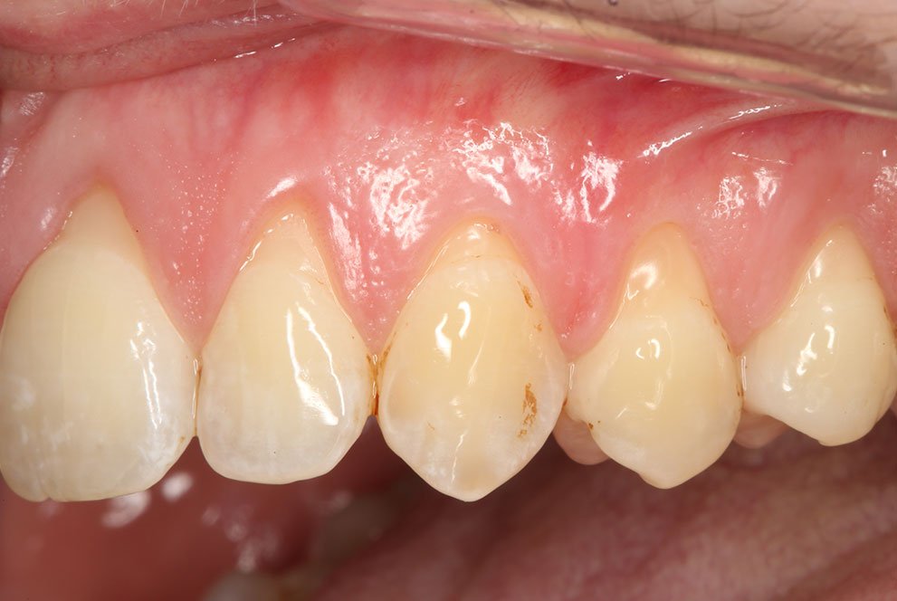 Receding gums Treatment Weybridge Retreating gums Woking